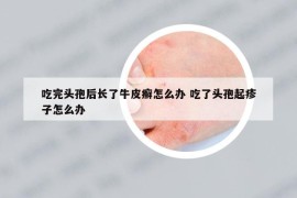 吃完头孢后长了牛皮癣怎么办 吃了头孢起疹子怎么办