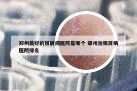 郑州最好的银屑病医院是哪个 郑州治银屑病医院排名