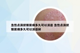 急性点滴状银屑病多久可以消退 急性点滴状银屑病多久可以消退掉