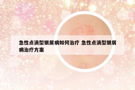 急性点滴型银屑病如何治疗 急性点滴型银屑病治疗方案