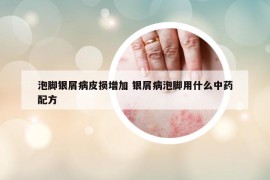 泡脚银屑病皮损增加 银屑病泡脚用什么中药配方