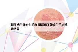 银屑病不能吃牛羊肉 银屑病不能吃牛羊肉吗请回答