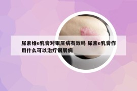 尿素维e乳膏对银屑病有效吗 尿素e乳膏作用什么可以治疗银屑病