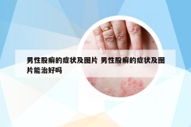 男性股癣的症状及图片 男性股癣的症状及图片能治好吗