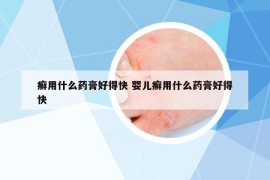 癣用什么药膏好得快 婴儿癣用什么药膏好得快