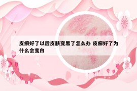 皮癣好了以后皮肤变黑了怎么办 皮癣好了为什么会变白