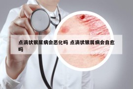 点滴状银屑病会恶化吗 点滴状银屑病会自愈吗