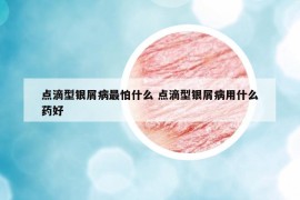 点滴型银屑病最怕什么 点滴型银屑病用什么药好