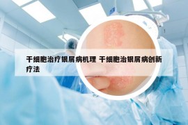 干细胞治疗银屑病机理 干细胞治银屑病创新疗法