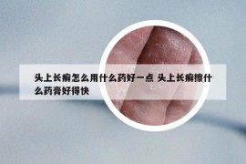 头上长癣怎么用什么药好一点 头上长癣擦什么药膏好得快