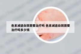 色素减退白斑需要治疗吗 色素减退白斑需要治疗吗多少钱