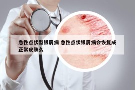 急性点状型银屑病 急性点状银屑病会恢复成正常皮肤么