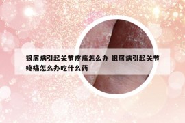 银屑病引起关节疼痛怎么办 银屑病引起关节疼痛怎么办吃什么药