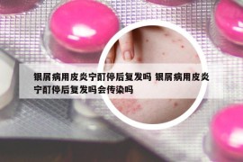 银屑病用皮炎宁酊停后复发吗 银屑病用皮炎宁酊停后复发吗会传染吗