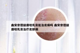 曲安奈德益康唑乳膏能治皮癣吗 曲安奈德益康唑乳膏治疗皮肤病