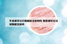 牛皮癣可以打胸腺肽注射剂吗 银屑病可以注射胸腺五肽吗