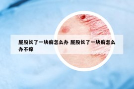 屁股长了一块癣怎么办 屁股长了一块癣怎么办不痒