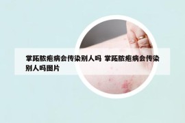 掌跖脓疱病会传染别人吗 掌跖脓疱病会传染别人吗图片