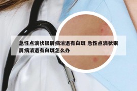 急性点滴状银屑病消退有白斑 急性点滴状银屑病消退有白斑怎么办