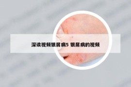 深读视频银屑病5 银屑病的视频