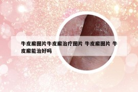 牛皮廨图片牛皮廨治疗图片 牛皮廨图片 牛皮廨能治好吗