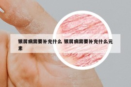 银屑病需要补充什么 银屑病需要补充什么元素