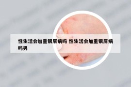 性生活会加重银屑病吗 性生活会加重银屑病吗男