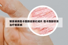 银屑病用他卡西醇皮肤红成片 他卡西醇软膏治疗银屑病