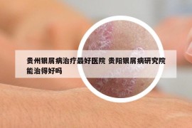 贵州银屑病治疗最好医院 贵阳银屑病研究院能治得好吗