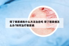 得了银屑病有什么方法治愈吗 得了银屑病怎么办?如何治疗银屑病