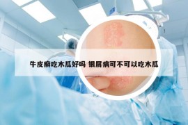 牛皮癣吃木瓜好吗 银屑病可不可以吃木瓜