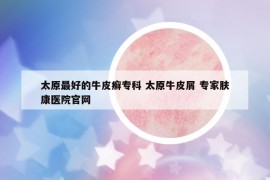 太原最好的牛皮癣专科 太原牛皮屑 专家肤康医院官网