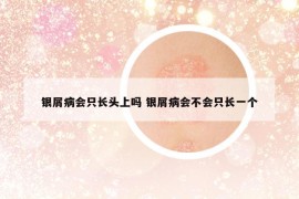 银屑病会只长头上吗 银屑病会不会只长一个