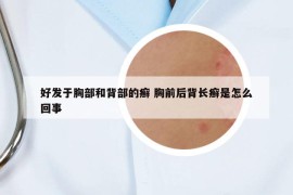 好发于胸部和背部的癣 胸前后背长癣是怎么回事