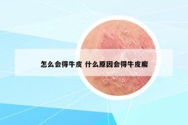 怎么会得牛皮 什么原因会得牛皮廨