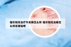 福尔阳光治疗牛皮癣怎么样 福尔阳光治癣怎么样百度贴吧