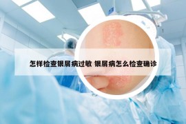 怎样检查银屑病过敏 银屑病怎么检查确诊