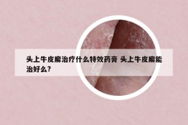 头上牛皮廨治疗什么特效药膏 头上牛皮廨能治好么?