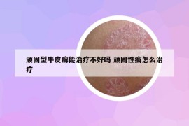 顽固型牛皮癣能治疗不好吗 顽固性癣怎么治疗