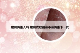 银屑传染人吗 银屑皮肤病会不会传染下一代