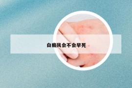 白癜风会不会早死