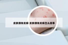 皮肤偶有皮癣 皮肤偶有皮癣怎么回事