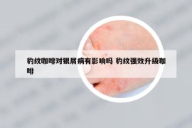 豹纹咖啡对银屑病有影响吗 豹纹强效升级咖啡