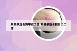 银屑病适合做哪些工作 银屑病适合做什么工作