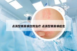 点滴型银屑病住院治疗 点滴型银屑病痊愈