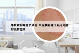 牛皮肤癣用什么药膏 牛皮肤癣用什么药膏最好没有激素