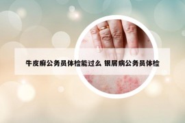 牛皮癣公务员体检能过么 银屑病公务员体检