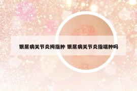 银屑病关节炎拇指肿 银屑病关节炎指端肿吗