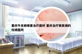 重庆牛皮癣哪里治疗最好 重庆治疗银屑病的权威医院