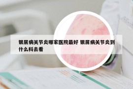 银屑病关节炎哪家医院最好 银屑病关节炎到什么科去看